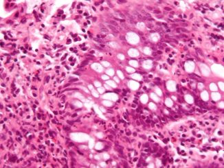 Mikrografi som visar inflammation i tjocktarmen i ett fall av inflammatorisk tarmsjukdom. Biopsi från tjocktarmen. Kredit: Wikipedia/CC BY-SA 3.0